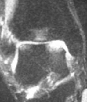 IndependentAdverseOutcomesAssociatedWithUncontainedLesionso fthe Talar Shoulder.