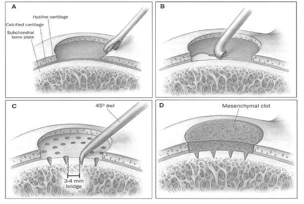 Artroscopia: microfracturas Garcia R, Millán I, Martín C, Vilá y Rico J: Tratamiento artróscópico de las lesiones