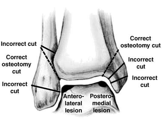 : Treatment of osteochondral lesions of the talus by means of