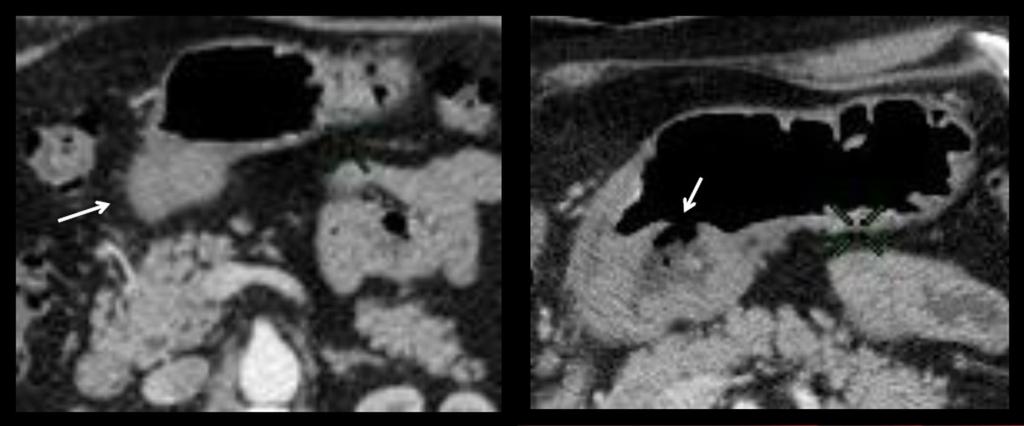 Fig. 5: Imágenes axiales de TC del mismo paciente a dos niveles distintos: a (inferior) y b (superior).