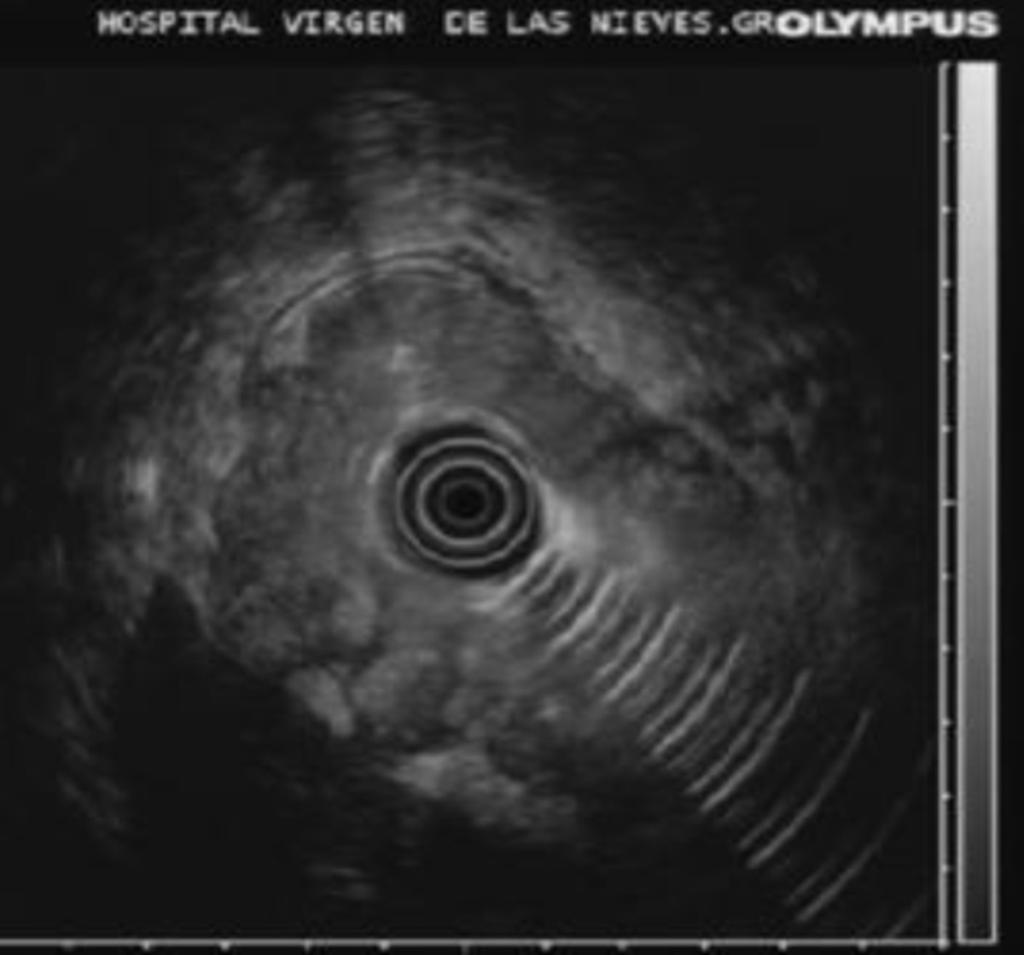 Fig. 8: Imagen de ecografía endoscópica que muestra una tumoración