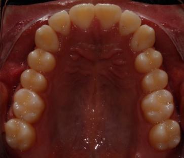 La cresta infracigomática en el maxilar 8, el shelf mandibular y/o