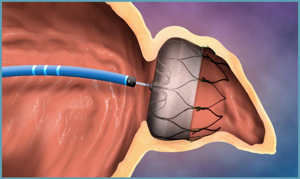- designed to engage tissue for stability Proximal Face Minimizes surface area facing the left atrium to reduce post-implant thrombus formation 160