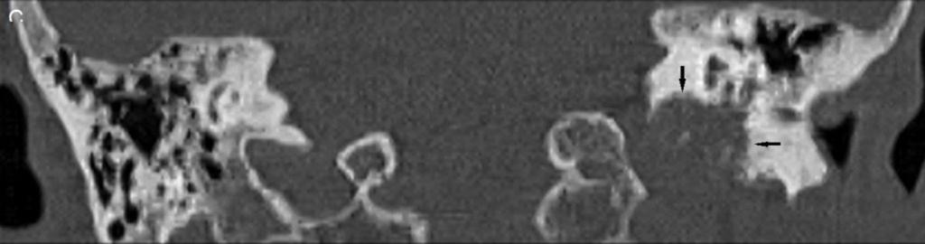 Fig. 5: Figura 2C. Paraganglioma yugular. A-C. Imágenes de TC de peñasco con civ. A: Imagen axial, ventana de tejidos blandos.