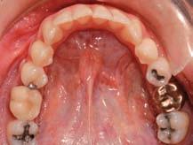 dientes posteriores, y de un tornillo que las une situado en medio del paladar, y