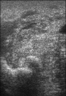 Exámenes complementários Ultrasonografia: Caracterización de la exostosis RF 5 cm PACB (transversal) Afectación de