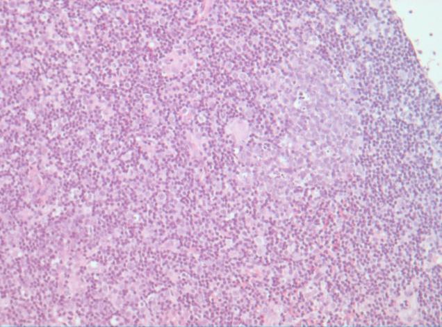 Malaltia de Kikuchi La histologia ganglionar mostra en les zones paracorticals, en més o menys grau, depenent de l evolució de la malaltia, àrees de necrosi rodejades d histiòcits molts d ells de