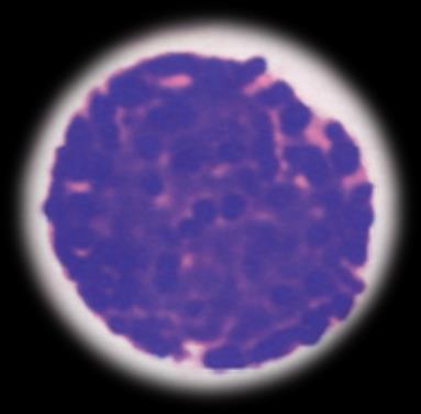 Leucemia de células Dendríticas