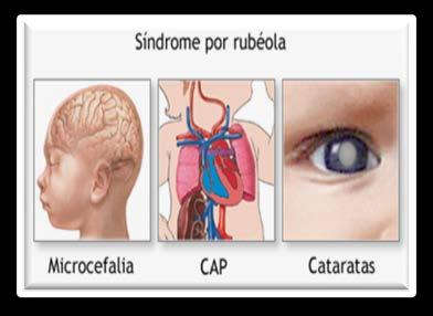 CLASIFICACIÓN DE CASOS Caso sospechoso Todo niño menor de un año que presente uno o más de los siguientes signos: catarata congénita, (ceguera) Hepatoesplenomegalia (hígado y bazo agrandado),