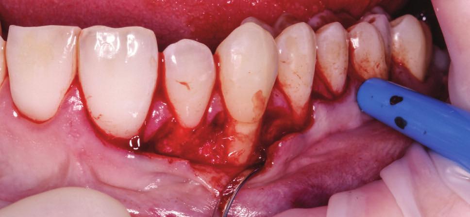 pasivamente el limite amelocementario de los dientes tratados y cuando las papilas quirúrgicas cubrían a las papilas anatómicas (Figura 5).