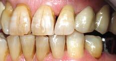 DESPUÉS Gracias a su color básico intenso y a sus efectos de esmalte, la nueva corona 22 se integra armoniosamente entre los dientes