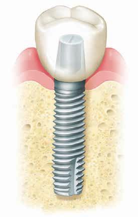 Cuanto más sepa el equipo dental sobre sus antecedentes médicos y dentales, mayores serán las probabilidades de éxito en la cirugía de implante.