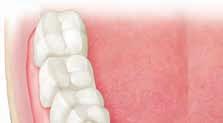 Tipos de prótesis completas Hay dos tipos de dentaduras postizas