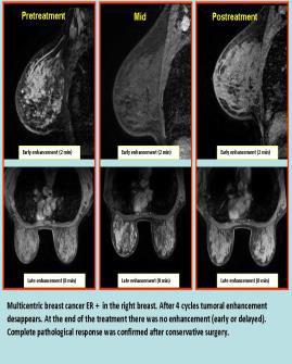 On the basis of the final MRI, response was determined to be a clinically complete response (CCR) when no residual tumor and no late enhancement were found.