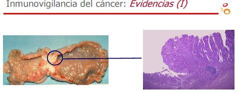 EVIDENCIAS DE LA ACCIÓN DEL SISTEMA INMUNE Infiltración de tumores con linfocitos y macrófagos.