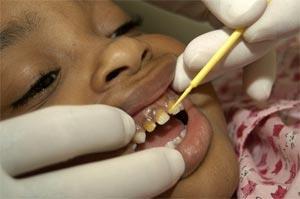 efectividad en reducir la incidencia de caries en niños y adolescentes (2) La prevención y el control de la caries dental, mediante fluoruros, es la