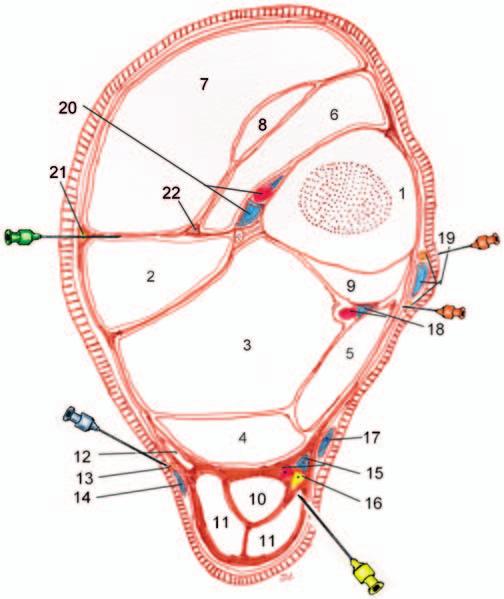 18 Desensibiliza Las mismas estructuras que la Metatarsiana Proximal Articulaciones del Tarso (incluidos Ligamentos) Ligamento Suspensor Parte Distal del Tendón Calcáneo Común Brida Tarsiana