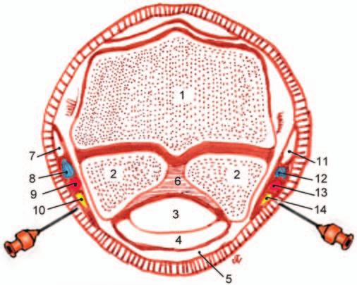 6 Desensibiliza distalmente al punto de inyección Las Tres Falanges Articulaciones Interfalángicas Proximal y Distal Corion del Casco Ramas Extensoras del Ligamento Suspensor del Menudillo Ligamentos