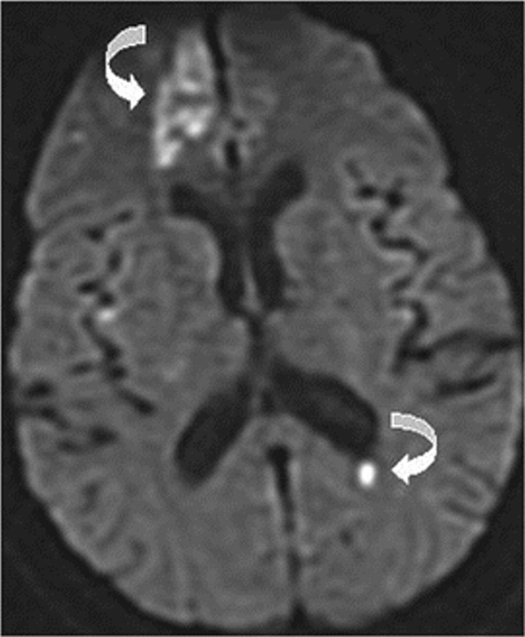 Ischemic stroke and microinfarct.