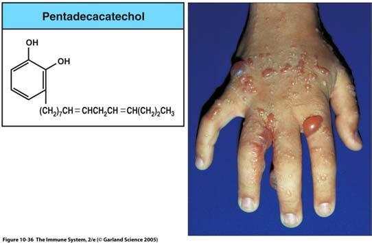 CD8 Granuloma tuberculoso Dermatitis
