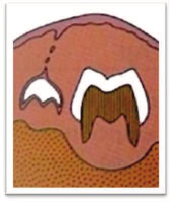Fig. No. 8: Período preeruptivo de molares primarios y permanentes. Fuente: Avery J.K., Chiego D.J. Principios de histología y embriología bucal con orientación clínica. 3ª Ed.