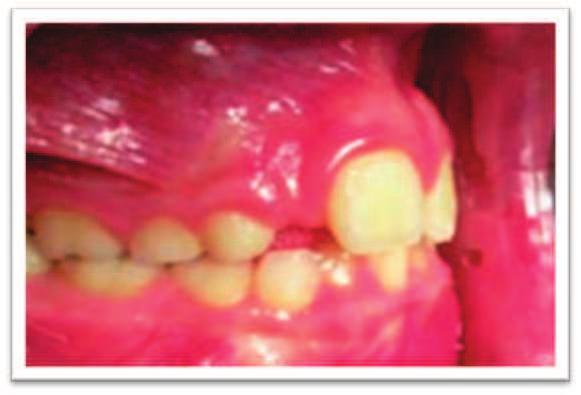 ante esta afección es el espaciamiento que se produce entre los dientes brotados con la correspondiente ruptura del equilibrio dentario y las consecuentes afecciones de la oclusión (13).