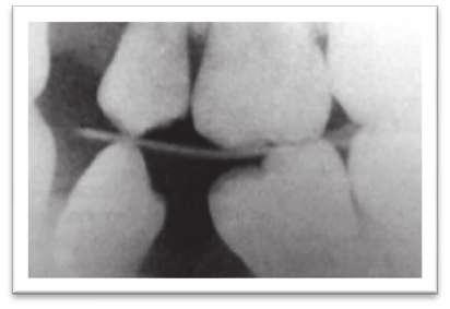 37: Se produjo un desplazamiento anterior de los dientes posteriores