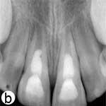 Permanent Incisors after Severe