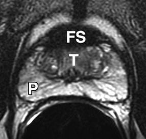 Stroma fibromuscular anterior Como un escudo sobre la prostata anterior Negro en T1 and T2 Claus FG et al.