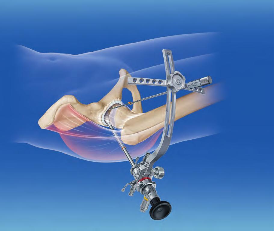 Cadera Sistemas de acceso para la artroscopia de la cadera El sistema HPS Hip Portal System representa la síntesis ideal entre un sistema de acceso y artroscopia combinado con diferentes instrumentos