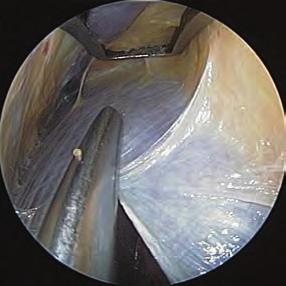 Mediante la técnica endoscópica, no solamente se reduce la incisión a 1,5 2 cm, sino que se alarga también el trayecto de la neurólisis de manera esencial (15 20 cm).