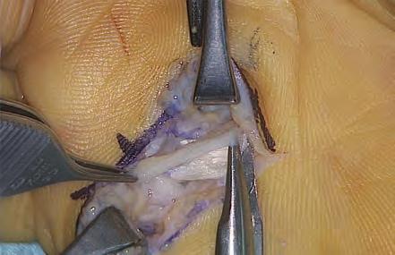 quirúrgicas de la mano: Fasciectomía (contractura Dupuytren) Artroplastia Osteotomía de