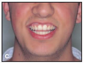 Fig 04. Tipos de sonrisa con respecto a la curvatura del labio superior. A. Baja. B. recta. C. alta Fuente: Sabri, (2005). 3.2.6.