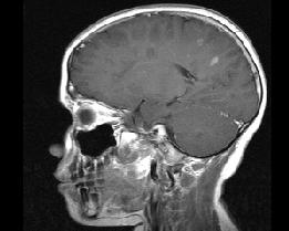 Nuevas lesiones en el cerebro, incluidas nuevas lesiones con captación