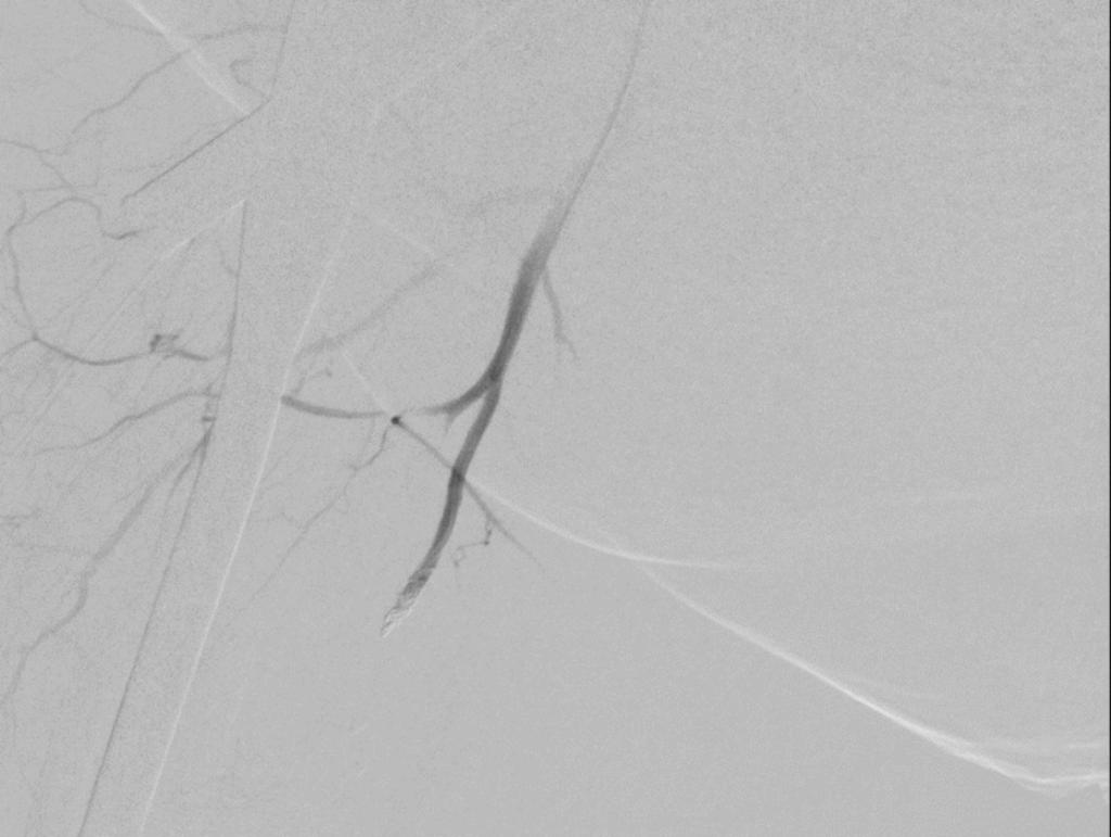 Fig. 12: Arteriografía selectiva de arteria femoral profunda derecha que en las series realizadas muestra teñido angiográfico patológico sugerente de extravasado activo de contraste dependiente de