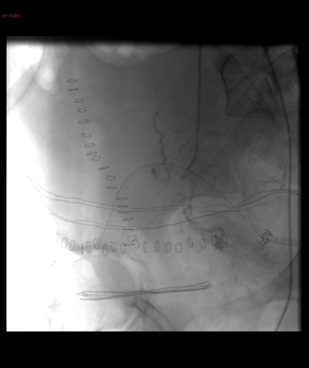 Fig. 18: Arteriografía supraselectiva de arteria uterina derecha en proyección similar a