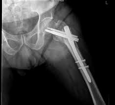 2.5 TRATAMIENTO El tratamiento de las fracturas de cadera en adultos mayores, siguen siendo un reto para los cirujanos ortopedistas por las comorbilidades que presentan este tipo de pacientes, y aun