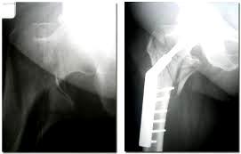 El tratamiento de las fracturas de la cadera debe ser quirúrgico pues esta es la forma con mayor posibilidad de recuperación.