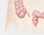 Colectomía sigmoide Se quita una parte o la totalidad del colon sigmoide. El colon descendente se vuelve a conectar con el recto.
