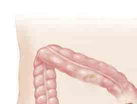 Si necesita un estoma Con algunas cirugías, uno de los extremos del intestino delgado se lleva a una abertura que se crea en la pared abdominal.