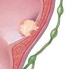 Con el paso del tiempo, un tumor canceroso puede crecer más arraigado en el colon.