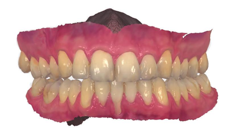Patient Specific Motion para el movimiento real del maxilar Ahora los doctores pueden escanear y registrar la articulación dinámica del paciente y cargarla en 3Shape Dental System con el caso.