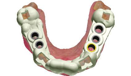 Con 3Shape Dental System usted puede diseñar incluso las restauraciones de implantes más avanzadas de una alta calidad estética y