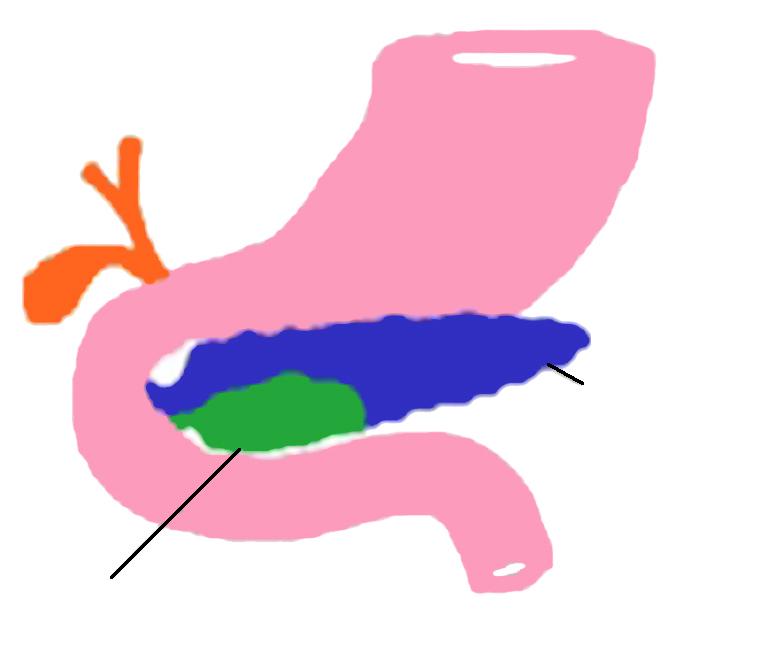 El PD no constituye una enfermedad, es una variación anatómica producida por una falla en la fusión del conducto ventral y dorsal durante la organogénesis, sin alteraciones en la fusión del