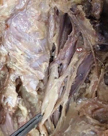 Se identifica el Nervio pudendo dividido en 3 ramos, 2 ramos del nervio se situan medialmente y el otro alteralmente a los Vasos pudendos (VP). Fig.