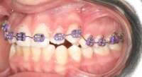 Clear Aligner in the upper arch to
