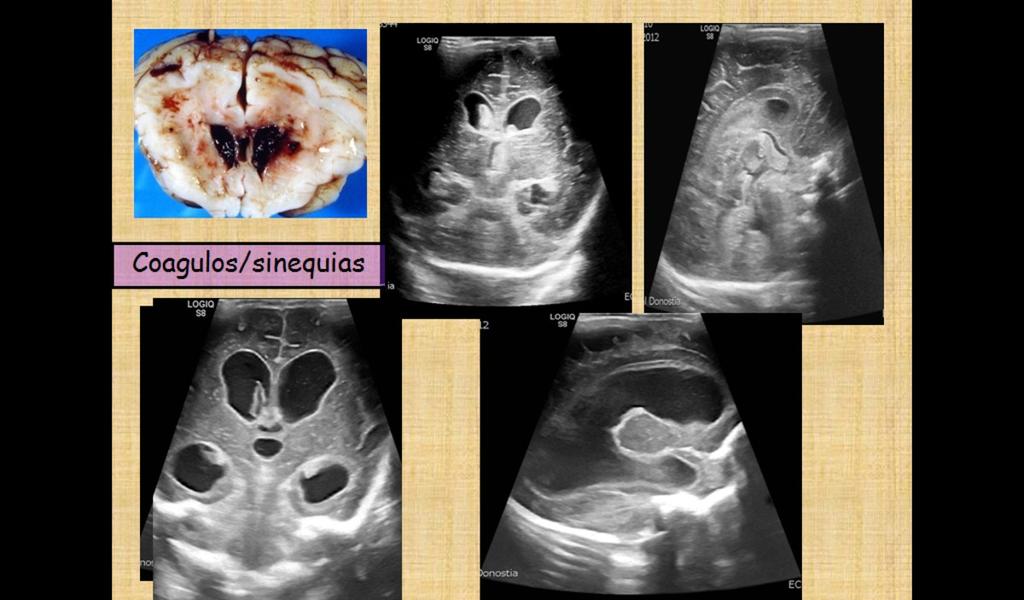 tectales). Cualquier tumor de la fosa posterior puede obstruir el cuarto ventrículo y/o la porción inferior del IV ventrículo (astrocitomas, meduloblastomas o hemangioblastomas).