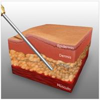 Liposucción El cirujano insertará la cánula de liposucción en la capa de grasa que se encuentra bajo la piel.