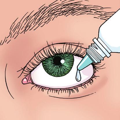 PREPARACIÓN DEL PACIENTE PARA LA INSERCIÓN INTRAVÍTREA DE ILUVIEN El tratamiento con Iluvien es exclusivamente para uso intravítreo, y deberá ser administrado por un oftalmólogo experimentado en la