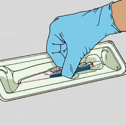 Hacer que el paciente mire hacia arriba, y apoyar un aplicador con punta de algodón embebido en el antiséptico apropiado en el lugar de la inserción.